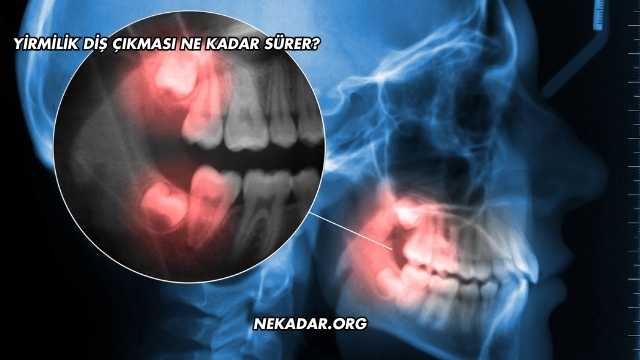 Yirmilik Diş Çıkması Ne Kadar Sürer?