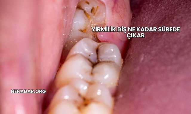 Yirmilik Diş Ne Kadar Sürede Çıkar